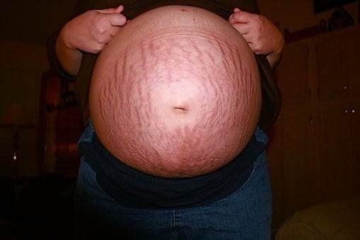 When And How Do Stretch Marks Appear During Pregnancy